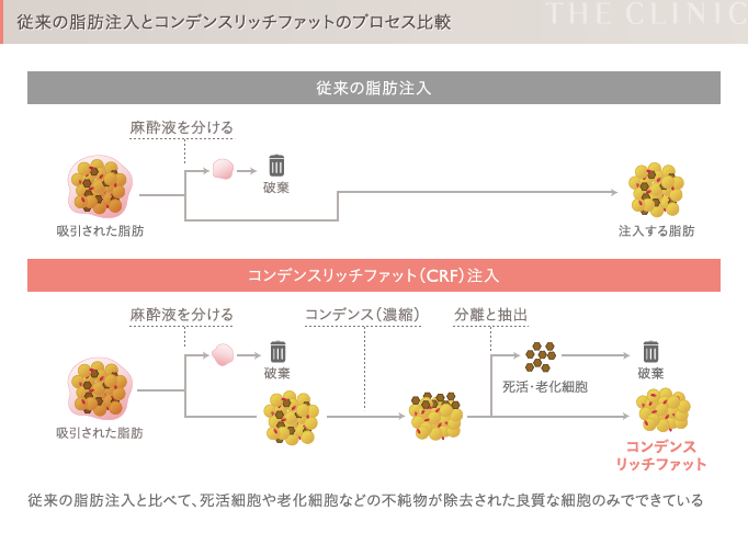 従来の脂肪注入とコンデンスリッチファット(CRF)注入の比較