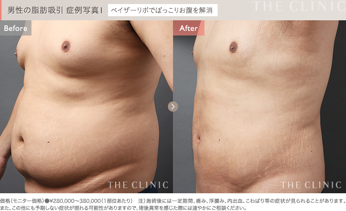 男性のお腹の脂肪吸引 症例写真1