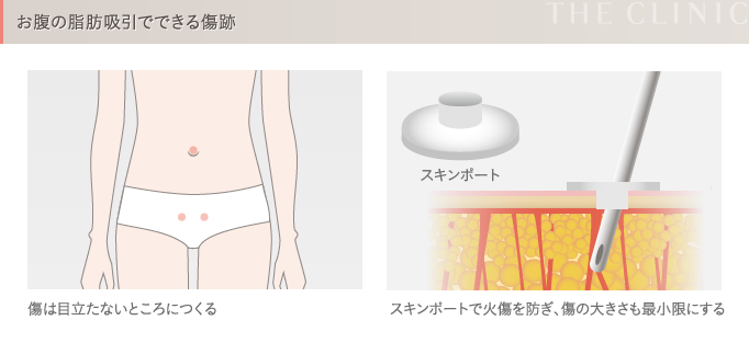 お腹の脂肪吸引の傷跡