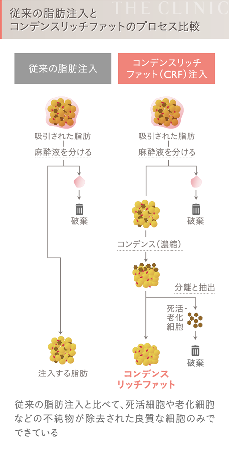 従来の脂肪注入とコンデンスリッチファット(CRF)注入の比較