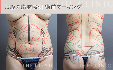 お腹の脂肪吸引 術前4Dマーキング