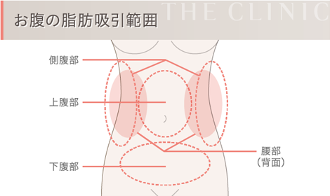 お腹の脂肪吸引範囲