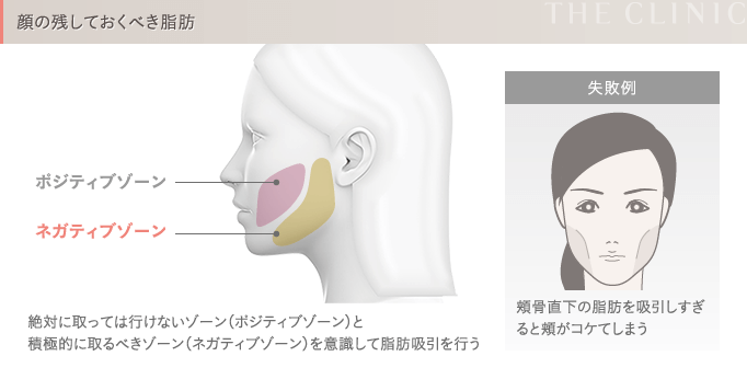 顔の脂肪吸引 残しておくべき脂肪