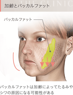 加齢とバッカルファット