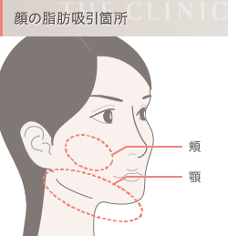 顔の脂肪吸引箇所