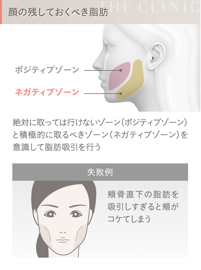 顔の脂肪吸引 残しておくべき脂肪