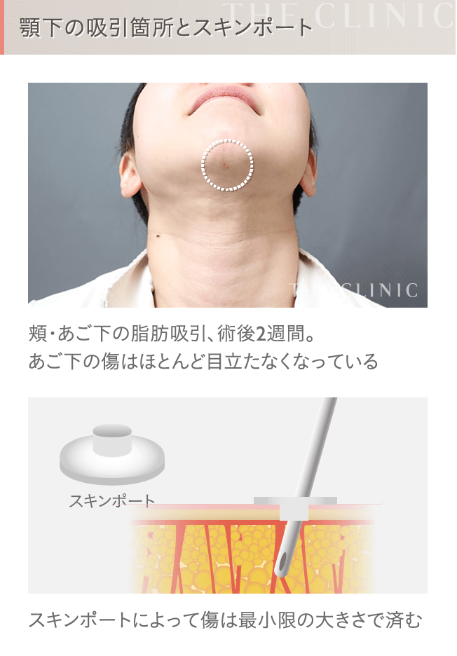 顔の脂肪吸引の傷跡