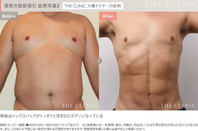 男性の脂肪吸引 症例写真3