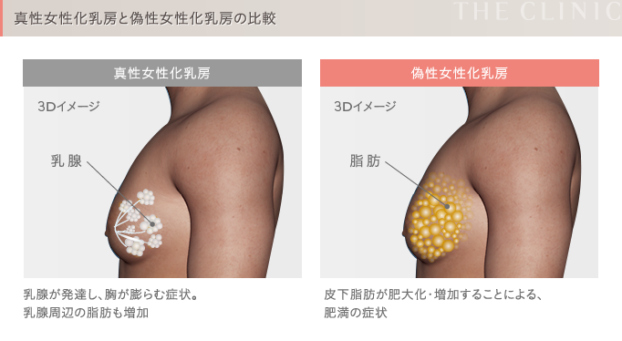 女性化乳房の種類