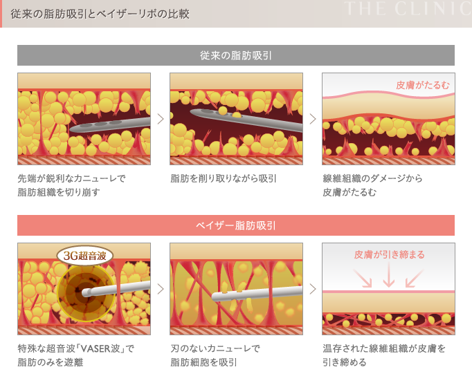 従来の脂肪吸引とベイザー脂肪吸引の比較