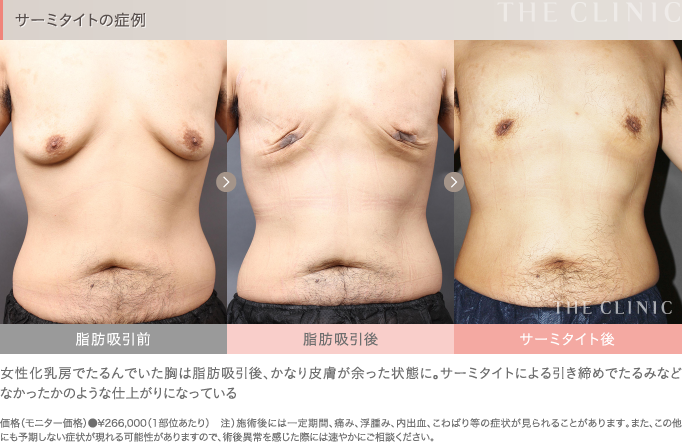サーミタイトの症例写真（男性の胸部）