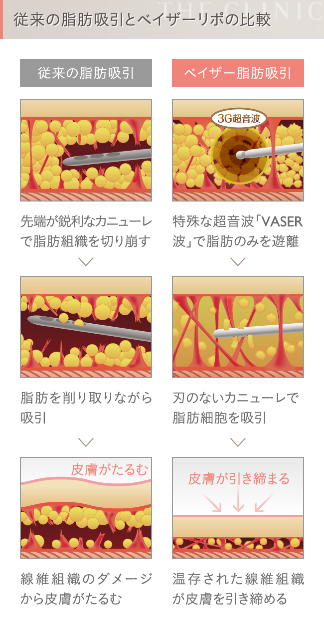 従来の脂肪吸引とベイザー脂肪吸引の比較