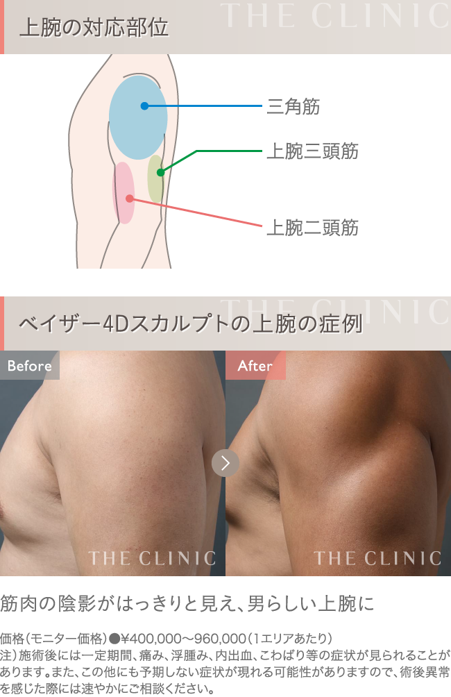 ベイザー4D脂肪吸引 上腕の症例写真