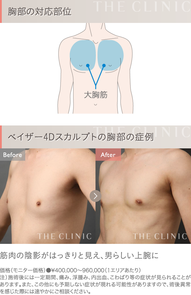 ベイザー4D脂肪吸引 胸部の症例写真