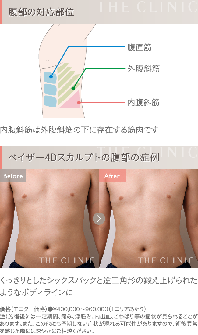 ベイザー4D脂肪吸引 お腹の症例写真