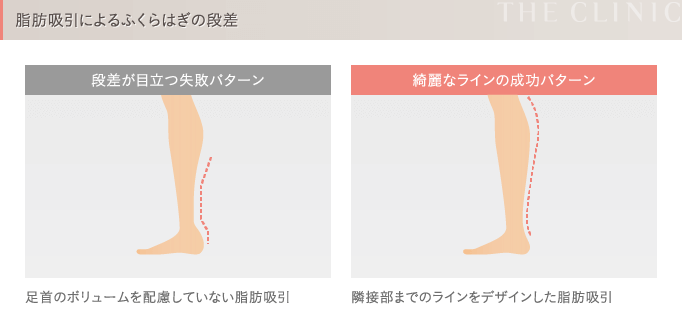 脂肪吸引の失敗2 段差