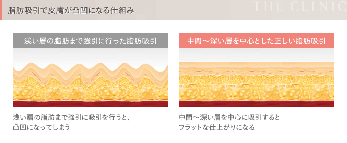 脂肪吸引の失敗3 デコボコになる