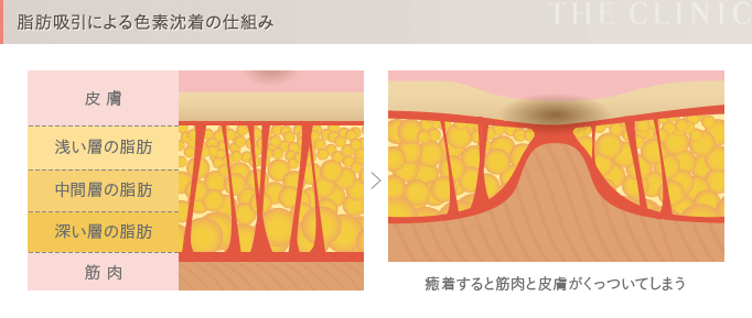 脂肪吸引の失敗4 色素沈着