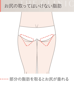 脂肪吸引で取ってはいけない脂肪