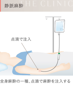 静脈麻酔