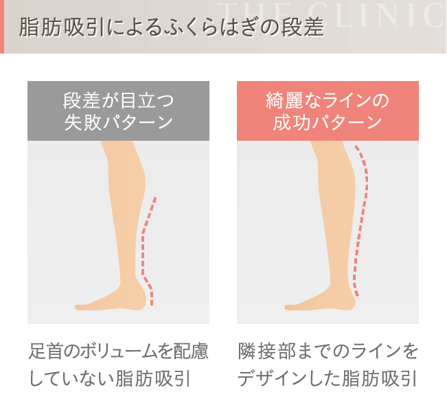 脂肪吸引の失敗2 段差