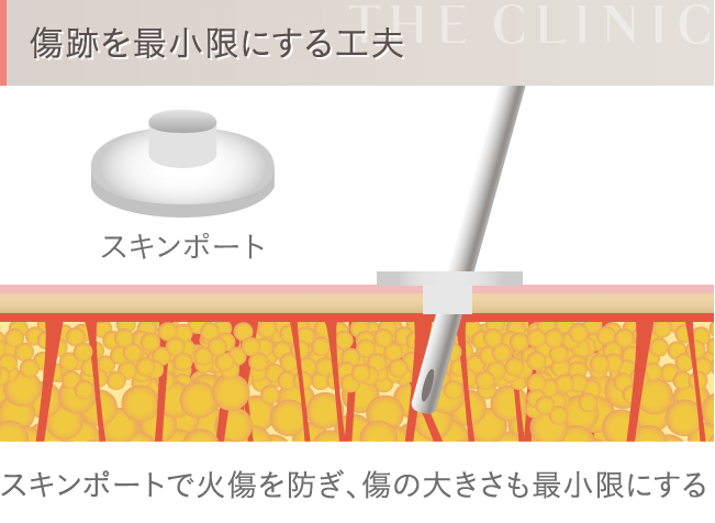 脂肪吸引の傷跡を最小限にする工夫