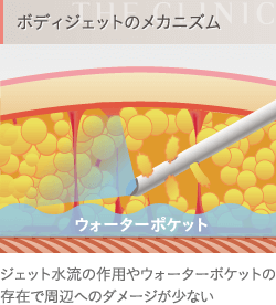 脂肪吸引（ボディジェット）のメカニズム