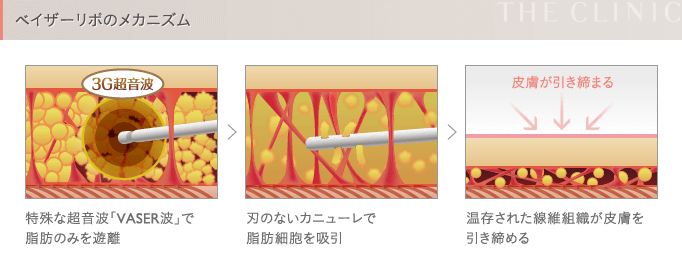 ベイザー脂肪吸引のメカニズム