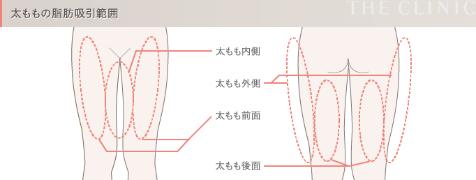 太ももの脂肪吸引範囲