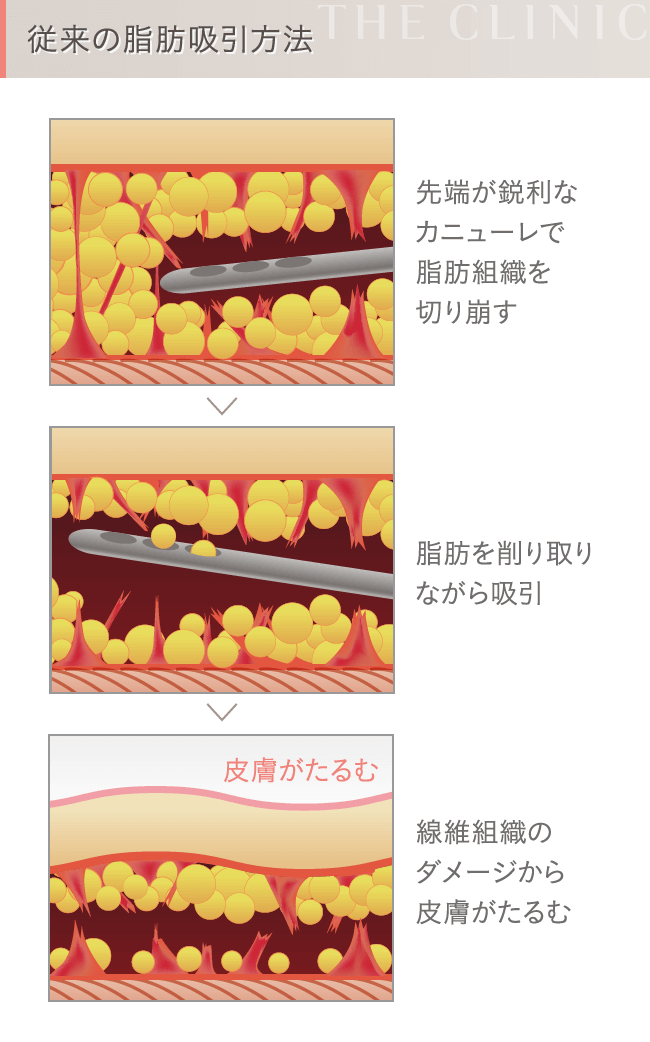 陰圧式脂肪吸引のメカニズム