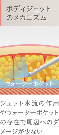 脂肪吸引（ボディジェット）のメカニズム