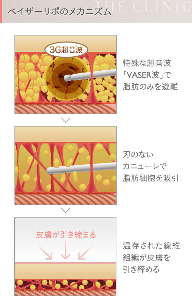 太ももの脂肪吸引Q&A|医師が教える脂肪吸引安心ガイド 太ももの脂肪吸引Q&A|医師が教える脂肪吸引安心ガイド