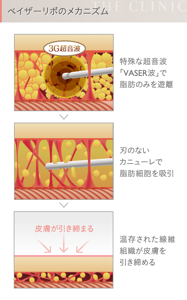 ベイザー脂肪吸引のメカニズム