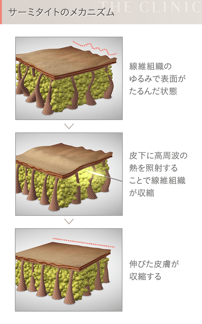 サーミタイトのメカニズム