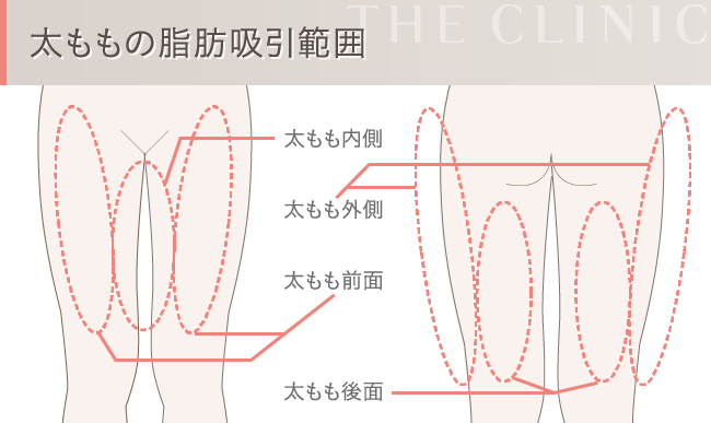 太ももの脂肪吸引範囲