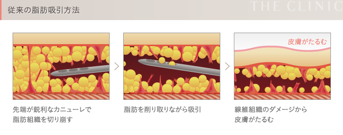 陰圧式脂肪吸引のメカニズム