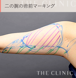 二の腕の脂肪吸引 術前4Dマーキング2