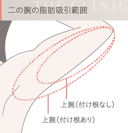 二の腕の脂肪吸引範囲