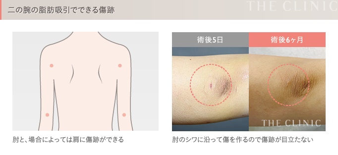 二の腕の脂肪吸引の傷跡