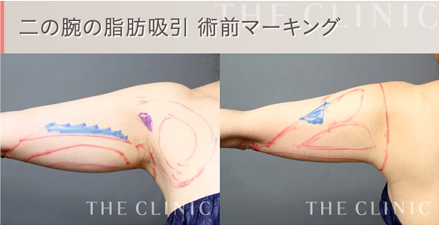 二の腕の脂肪吸引 術前4Dマーキング1