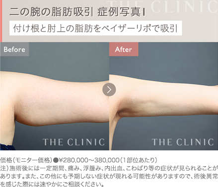 二の腕の脂肪吸引 症例写真1