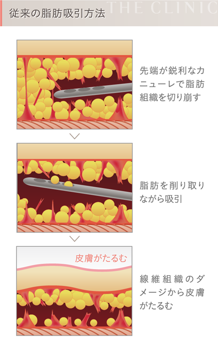 陰圧式脂肪吸引のメカニズム