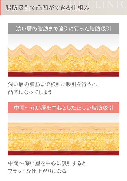 二の腕の脂肪吸引 失敗例2 デコボコ